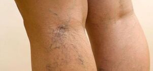 Varices dans les jambes